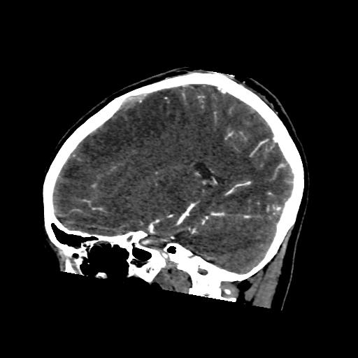 File:Cerebral venous throbmosis - hemorrhagic venous infarction (Radiopaedia 87318-103613 Sagittal CT venogram 17).jpg