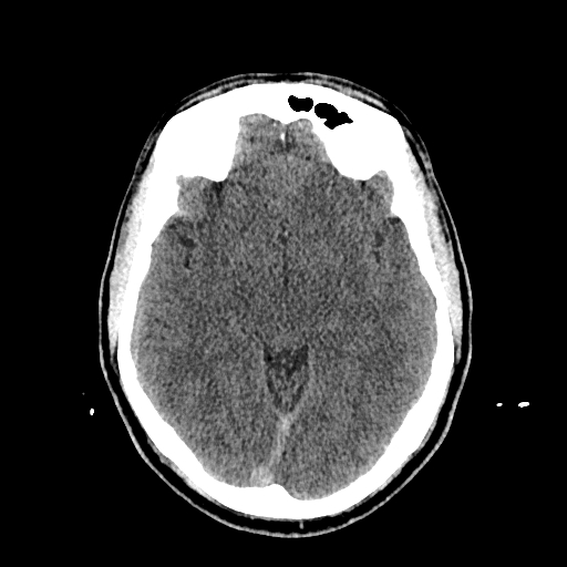 File:Cerebral venous thrombosis (CVT) (Radiopaedia 77524-89685 Axial non-contrast 21).jpg