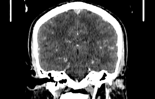 Cerebral venous thrombosis (CVT) (Radiopaedia 77524-89685 C 36).jpg