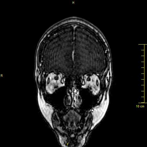 Cerebral venous thrombosis (Radiopaedia 23288-23351 MRV 5).JPG