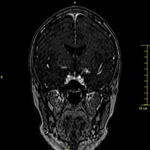 Cerebral venous thrombosis (Radiopaedia 23288-23351 MRV 56).JPG
