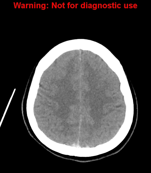 File:Cerebral venous thrombosis (Radiopaedia 37224-38992 Axial non-contrast 22).jpg