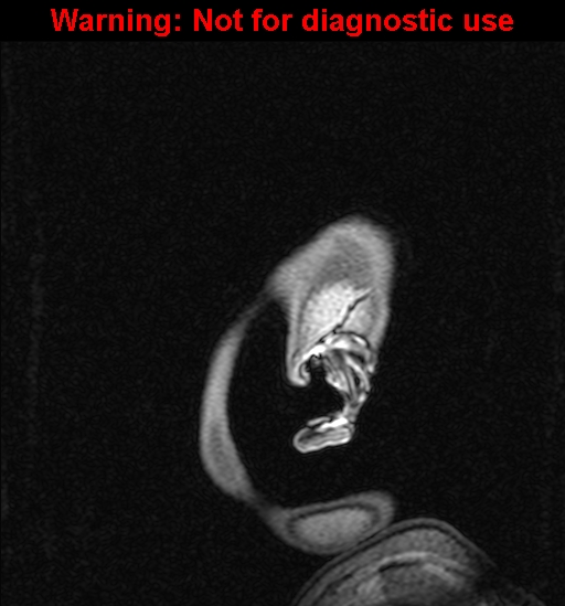 Cerebral venous thrombosis (Radiopaedia 37224-39208 Sagittal T1 C+ 155).jpg