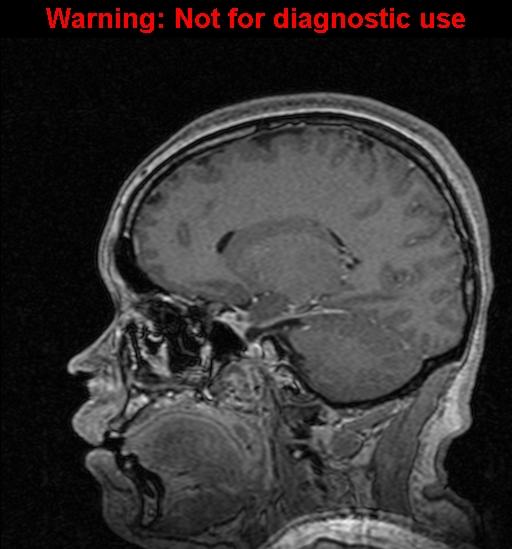 Cerebral venous thrombosis (Radiopaedia 37224-39208 Sagittal T1 C+ 61).jpg