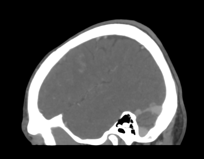 Cerebral venous thrombosis (Radiopaedia 38392-40467 D 11).png