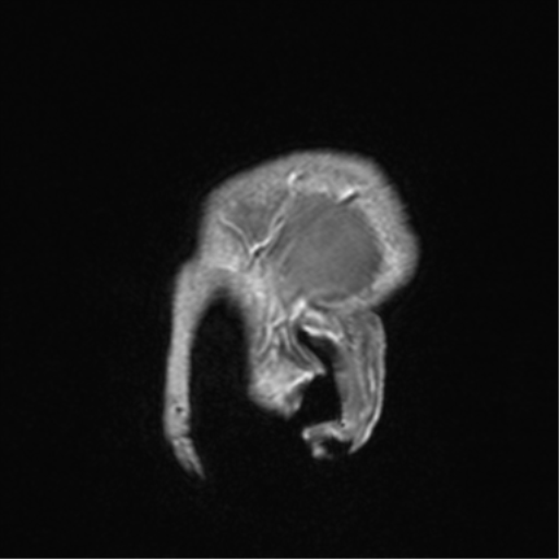 File:Cerebral venous thrombosis (Radiopaedia 38392-40469 Sagittal T1 C+ 8).png