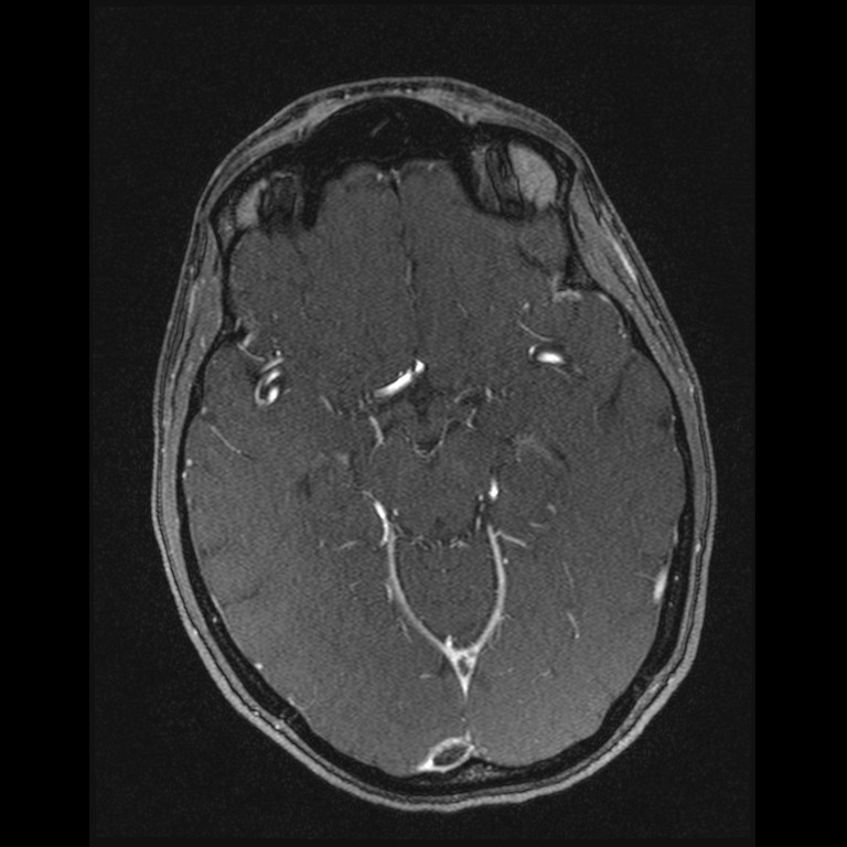 Cerebral venous thrombosis (Radiopaedia 45678-49854 Axial MRV 29).jpg