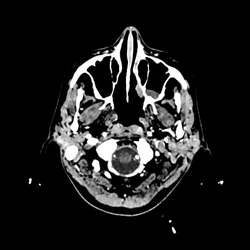 Cerebral venous thrombosis with venous hemorrhagic infarct (Radiopaedia 90354-107660 Axial with contrast 11).jpg