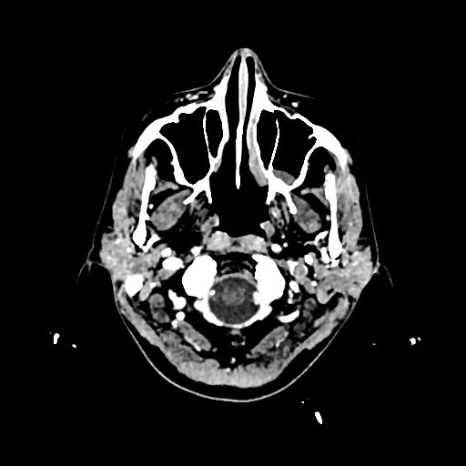 Cerebral venous thrombosis with venous hemorrhagic infarct (Radiopaedia 90354-107660 Axial with contrast 9).jpg
