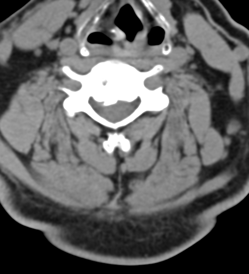 File:Cervical canal stenosis - OPLL and osteophytes (Radiopaedia 47329-51910 Axial non-contrast 34).png