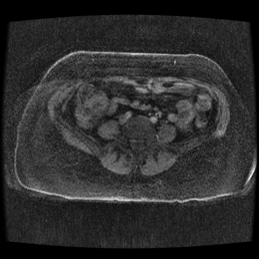 File:Cervical carcinoma (Radiopaedia 70924-81132 Axial T1 C+ fat sat 87).jpg