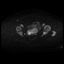 Cervical carcinoma (Radiopaedia 88010-104555 Axial DWI 68).jpg