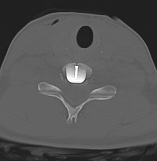 File:Cervical disc replacement (Radiopaedia 37383-39205 Axial bone window 10).png
