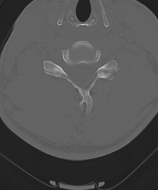 Cervical intercalary bone (Radiopaedia 35211-36748 Axial bone window 41).png