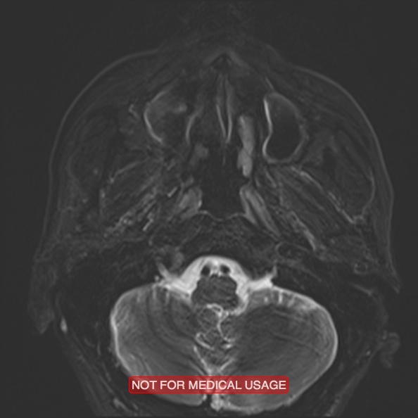 Cervical nerve schwannoma (Radiopaedia 27964-28221 C 16).jpg