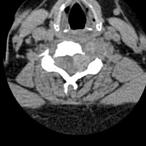 File:Cervical spinal neurofibroma in a patient with NF1 (Radiopaedia 58344-65464 Axial non-contrast 48).jpg
