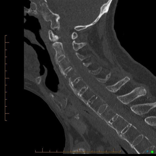 File:Cervical spine fracture - ankylosing spondylitis (Radiopaedia 76835-88706 Sagittal bone window 52).jpg