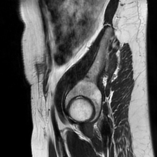 File:Cesarian section scar endometriosis (Radiopaedia 66520-75799 Sagittal T2 16).jpg
