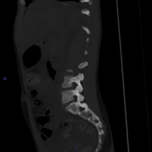 File:Chance fracture with duodenal and pancreatic lacerations (Radiopaedia 43477-50042 Sagittal bone window 19).jpg