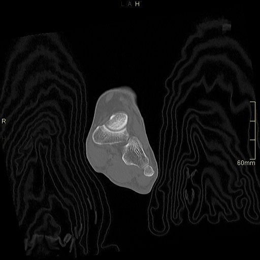 Chaput tubercle fracture (Radiopaedia 80319-93956 Coronal non-contrast 23).jpg