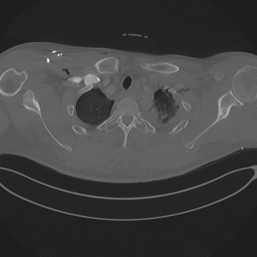 Chest multitrauma - aortic injury (Radiopaedia 34708-36147 Axial bone window 40).png