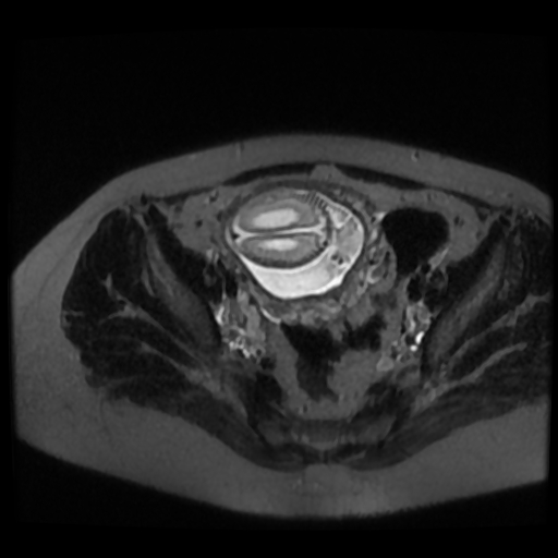 Chiari II malformation - fetal MRI (Radiopaedia 68099-77581 Axial T2-SSFSE 49).jpg