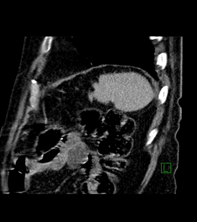 Cholangiocarcinoma with cerebral metastases (Radiopaedia 83519-98629 Sagittal C+ delayed 19).jpg