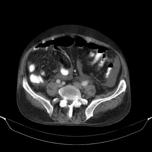 File:Cholangitis and abscess formation in a patient with cholangiocarcinoma (Radiopaedia 21194-21100 A 35).jpg