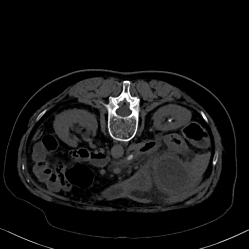 File:Cholecystitis - obstructive choledocholitiasis (CT intravenous cholangiography) (Radiopaedia 43966-47479 Axial 30).png