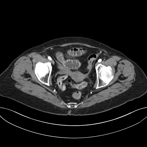 Cholecystoduodenal fistula due to calculous cholecystitis with gallstone migration (Radiopaedia 86875-103077 A 66).jpg