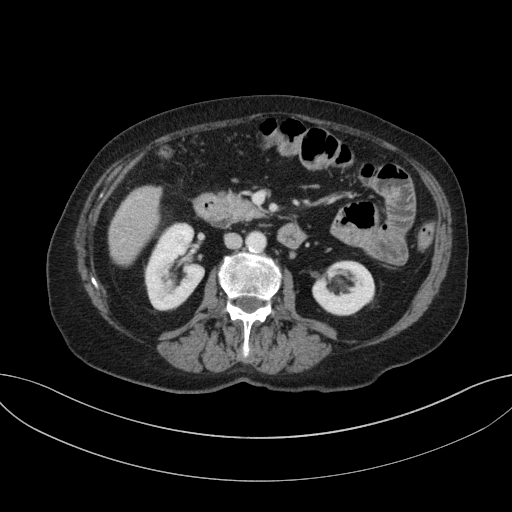 Cholecystoduodenal fistula due to calculous cholecystitis with gallstone migration (Radiopaedia 86875-103077 D 38).jpg