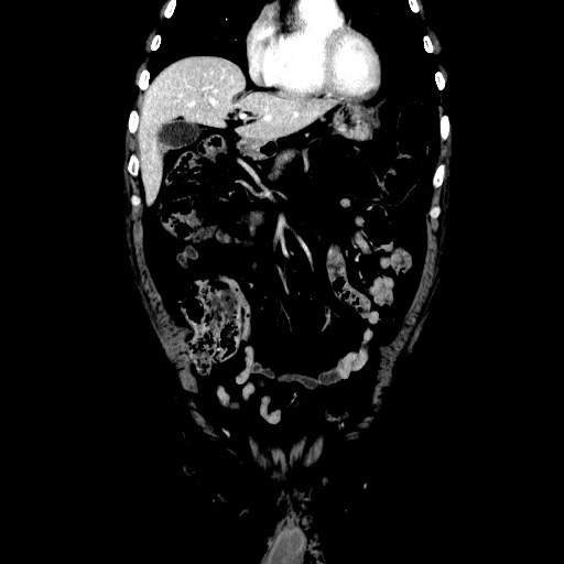 Choledocholiathiasis with normal caliber common bile duct (Radiopaedia 75368-86632 Coronal liver window 42).jpg