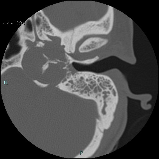 File:Cholesterol granuloma of the petrous apex (Radiopaedia 64358-73141 Axial bone window 60).jpg