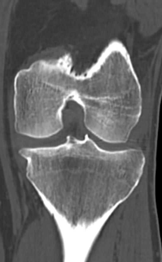 Chondrocalcinosis (Radiopaedia 82862-97173 Coronal bone window 49).jpg