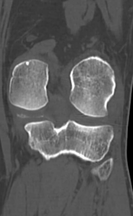 Chondrocalcinosis (Radiopaedia 82862-97173 Coronal bone window 55).jpg