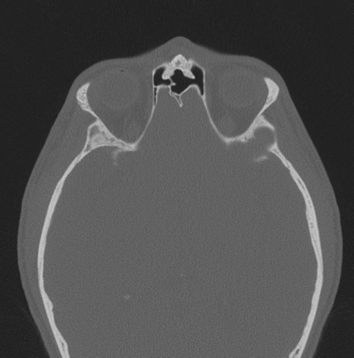 Chondrosarcoma (clivus) (Radiopaedia 46895-51425 Axial bone window 17).png