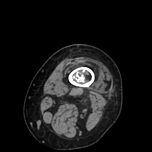 Chondrosarcoma - femur (Radiopaedia 64187-72954 Axial non-contrast 11).jpg