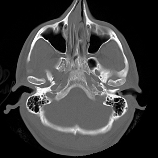 File:Chondrosarcoma - sphenoid wing (Radiopaedia 58259-67828 Axial bone window 3).jpg