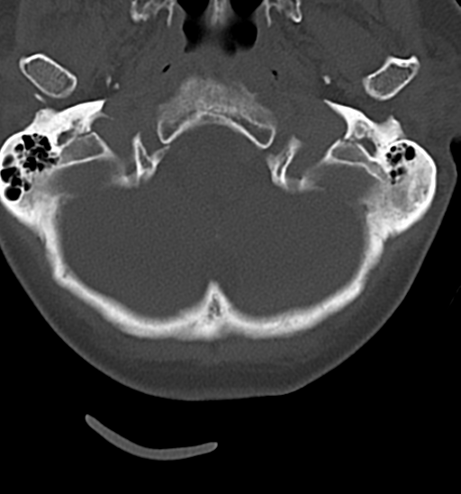 Chordoma (C4 vertebra) (Radiopaedia 47561-52188 Axial bone window 2).png