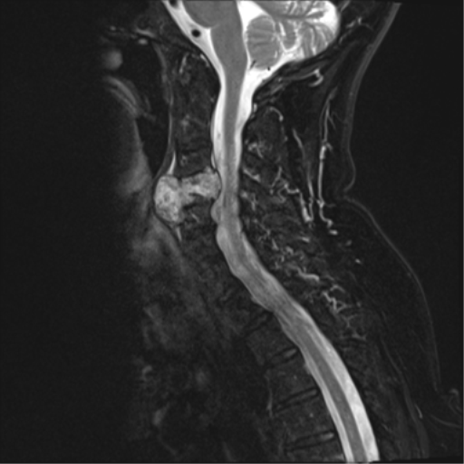 File:Chordoma (C4 vertebra) (Radiopaedia 47561-52189 Sagittal T2 fat sat 8).png