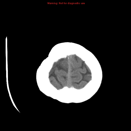 File:Choroid plexus carcinoma - recurrent (Radiopaedia 8330-9168 Axial non-contrast 26).jpg