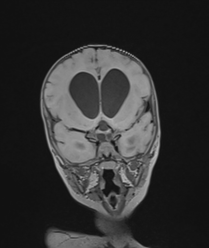 Choroid plexus papilloma (Radiopaedia 84612-100019 Coronal FLAIR 44).jpg