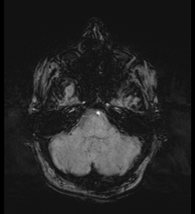 Choroid plexus xanthogranuloma (Radiopaedia 91271-108875 Axial SWI 15).jpg