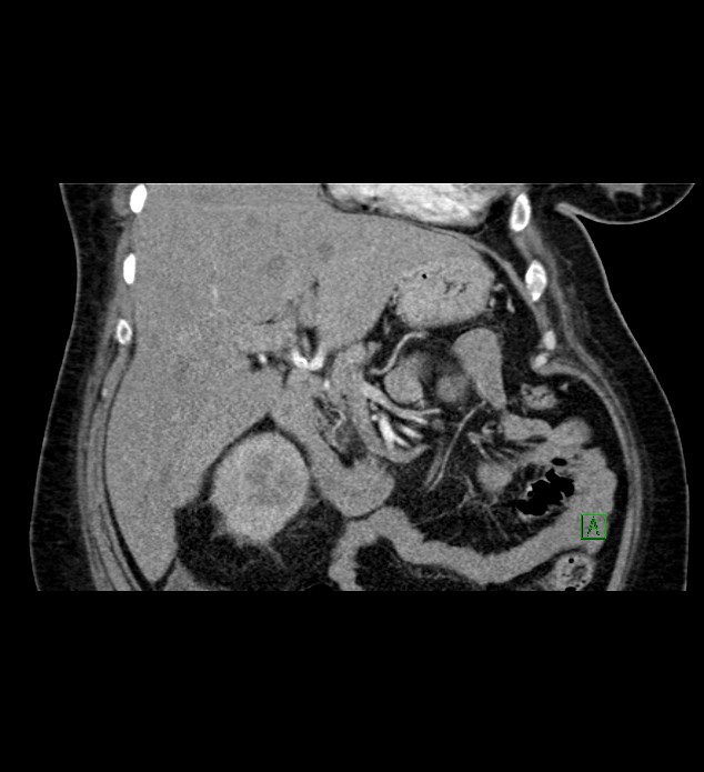 Chromophobe renal cell carcinoma (Radiopaedia 84239-99519 C 36).jpg
