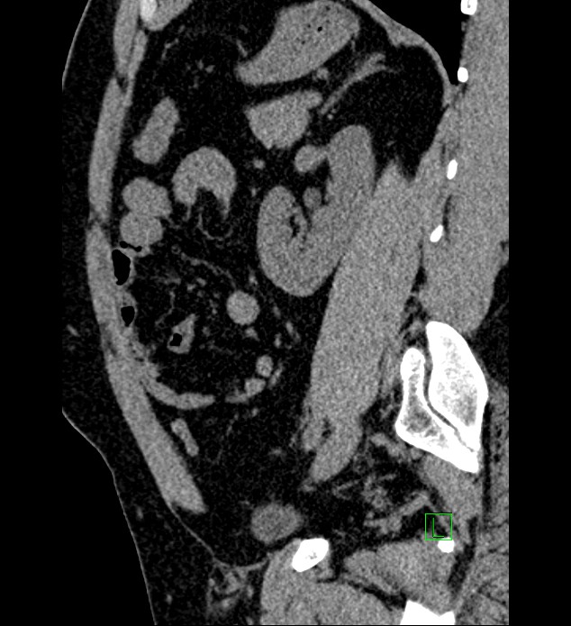 Chromophobe renal cell carcinoma (Radiopaedia 84286-99573 C 60).jpg
