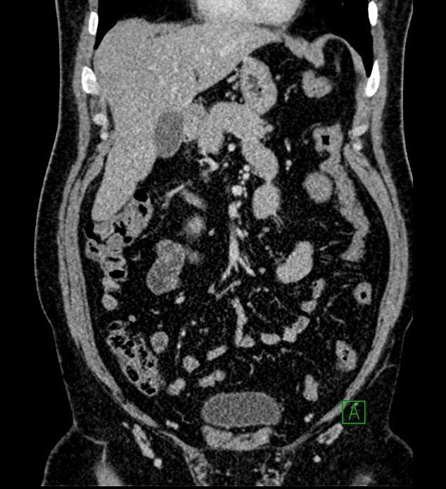 Chromophobe renal cell carcinoma (Radiopaedia 84286-99573 H 61).jpg