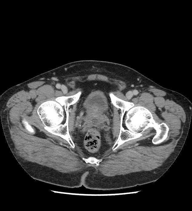 Chromophobe renal cell carcinoma (Radiopaedia 86879-103083 C 147).jpg
