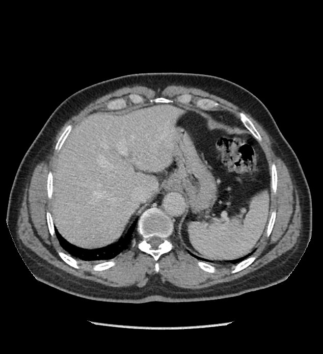 Chromophobe renal cell carcinoma (Radiopaedia 86879-103083 C 22).jpg