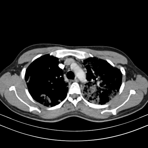 Chronic eosinophilic pneumonia (Radiopaedia 39331-41587 Axial C+ delayed 38).png