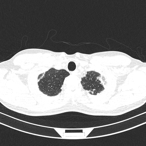 Chronic eosinophilic pneumonia (Radiopaedia 39331-41587 Axial lung window 5).png